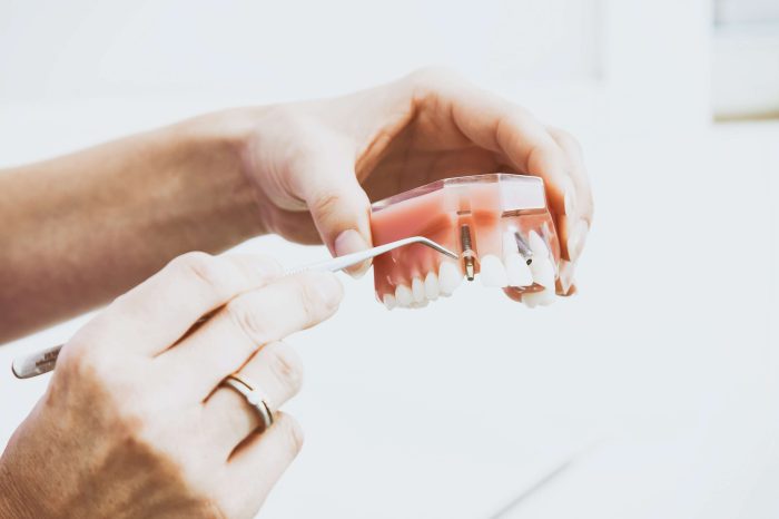 Dantų protezavimas, dantų protezai