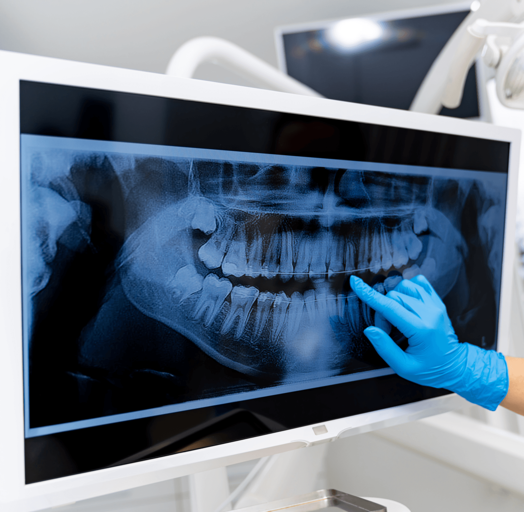 dantų rentgeno nuotrauka